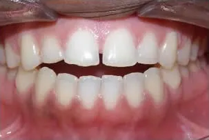 porcelain veneers smile two before