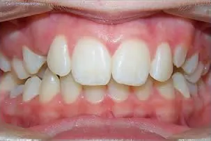 porcelain veneers smile three before