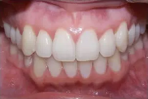 dental crowns after