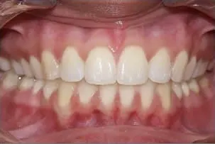 porcelain veneers smile two after